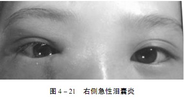 1,泪囊部红,肿,热,痛,重者同侧面部鼻部红肿,耳前及颌下淋巴结肿大