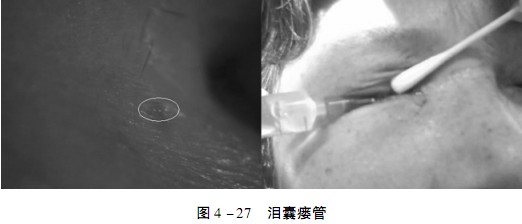 泪囊瘘管