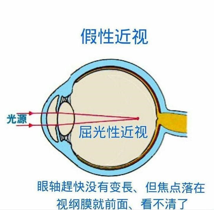 散瞳对眼睛有伤害吗?别让"谣言"耽误孩子矫正近视时机